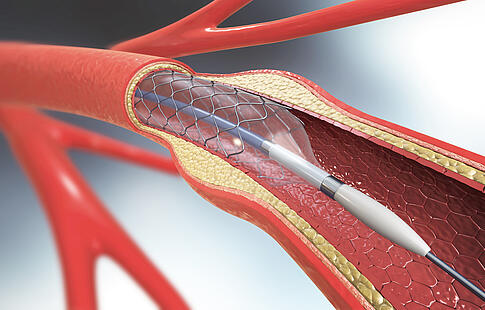 Gefäßchirurgie, Stent im Gefäß